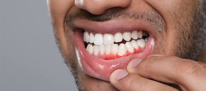 bleeding gums causes