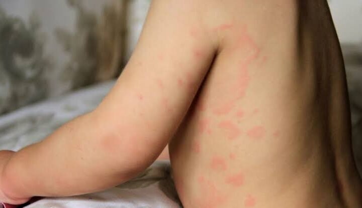 childhood allergies symptoms