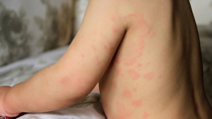 childhood allergies symptoms